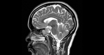 Adults who report a traumatic brain injury also report more road rage