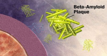 ‘Sewing machine’ idea gives insight into origins of Alzheimer’s disease