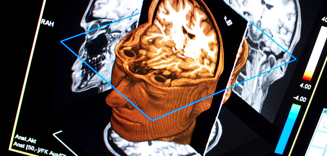 Insulin resistance increases risk for Alzheimer’s disease, study finds