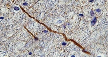 New protein biomarker identifies damaged brain wiring after concussion