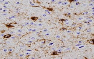 Protein associated with Parkinson’s travels from brain to gut