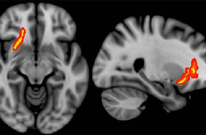 Mri Shows Brain Disruption In Children With Ptsd