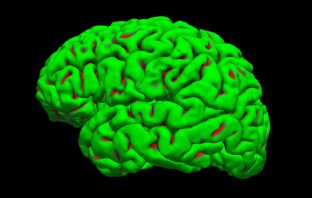 High-resolution brain scans could improve concussion detection