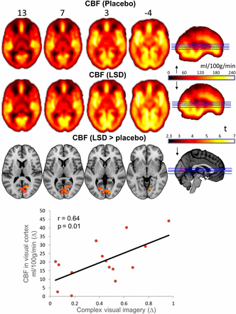 Whole-brain cerebral blood flow maps for the placebo and LSD conditions, plus the difference map. Credit: Nature