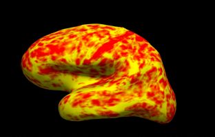 PET points to tau protein as leading culprit in Alzheimer’s