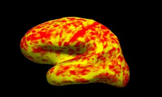 Cocaine addiction leads to build-up of iron in brain