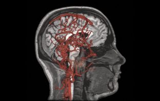 Clinical trial finds blood-plasma infusions to treat Alzheimer’s disease is safe and promising