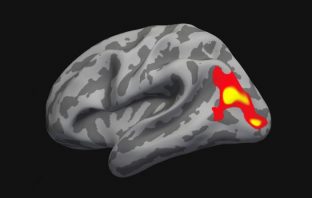 Psychotherapy normalizes the brain in social phobia