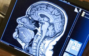 Brain lesions and criminal behavior linked to moral decision-making network