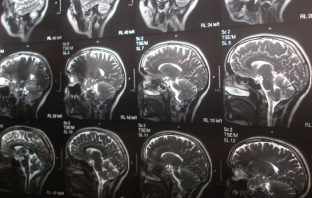 Higher blood pressure may be linked to brain disease and Alzheimer’s