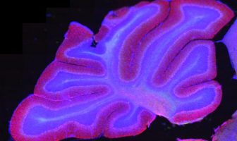 Brain stimulation improves schizophrenia-like cognitive problems