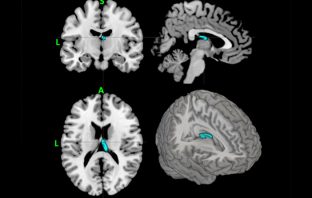 Psychologists enlist machine learning to help diagnose depression