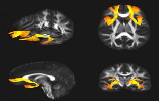 Scientists find shared genetics in schizophrenia and bipolar disorder
