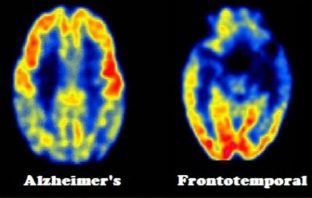 Study reveals staggering economic burden of dementia in younger people