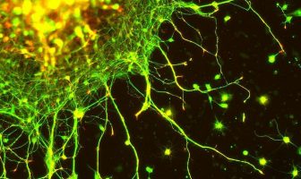 Scientists identify brain chemical abnormalities in earliest stage of psychosis
