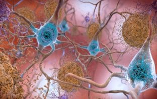 Scientists discover a non-invasive method to detect Alzheimer’s disease