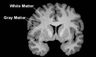 White matter alterations found in brains of college athletes after single football season