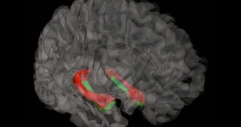 Reduced hippocampal volume observed in currently but not previously depressed older adults