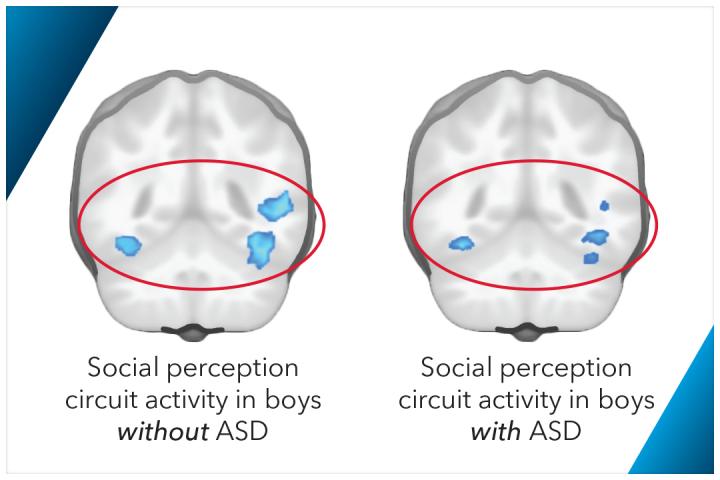 Possible Biomarker For Autism Discovered >> Researchers Identify New Functional Biomarker For Autism In Boys Possible Biomarker For Autism Discovered >> Researchers Identify New Functional Biomarker For Autism In Boys